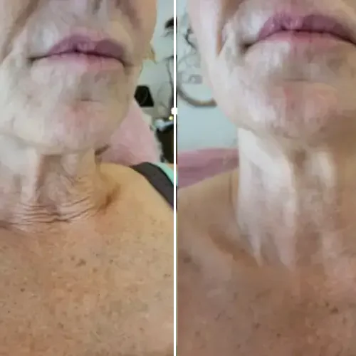 Resultaten voor en na Microneedling en mesotherapie Den Haag | Elite Beauty Center